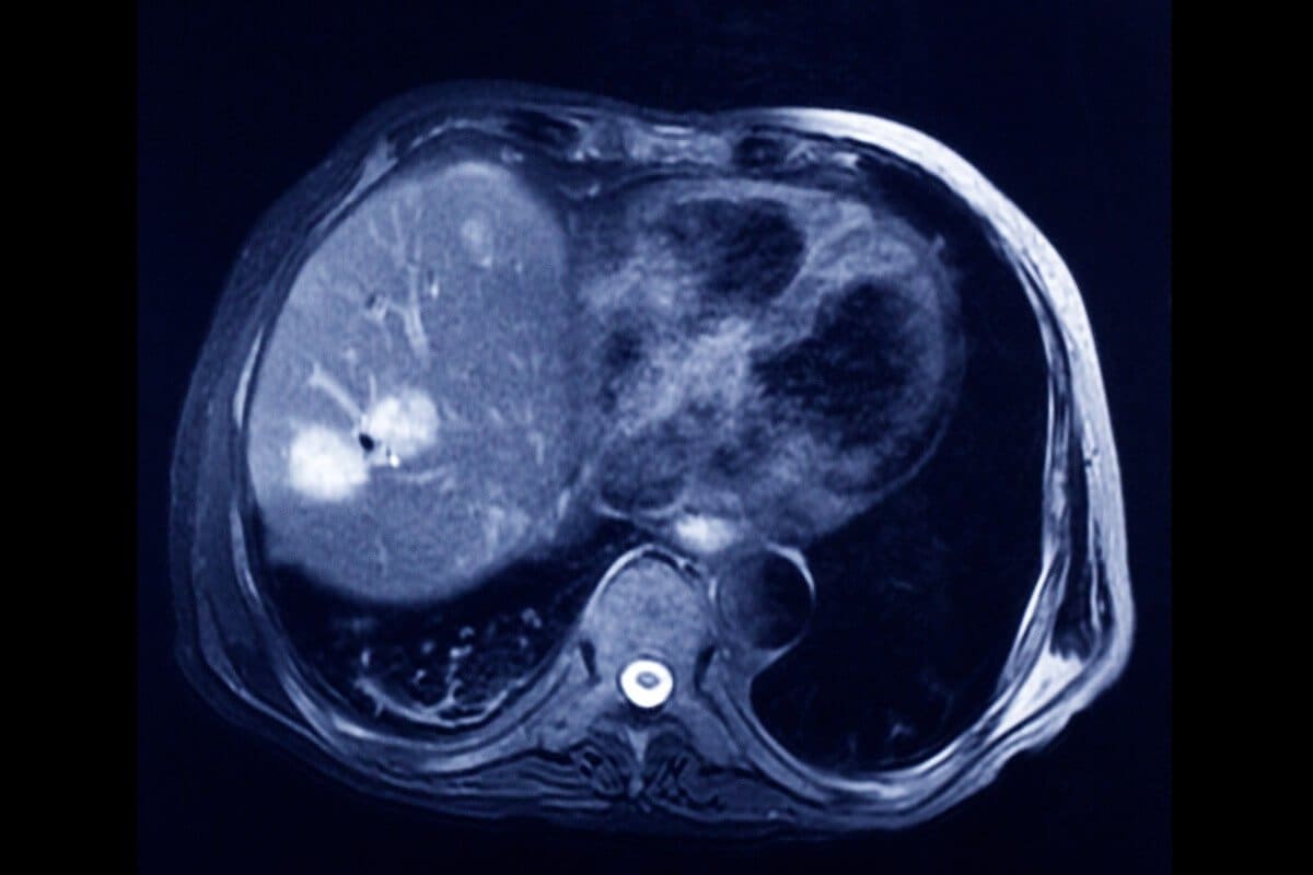 Alternative to CT Urogram: Does a CT Scan Detect Tumors?