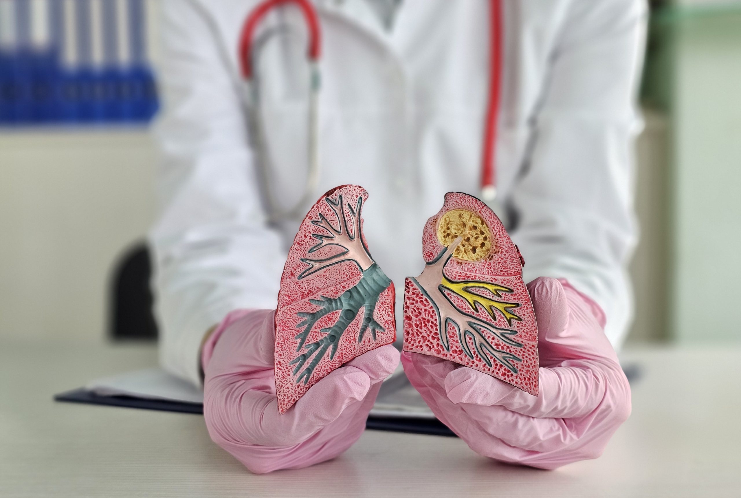 small cell lung cancer curable