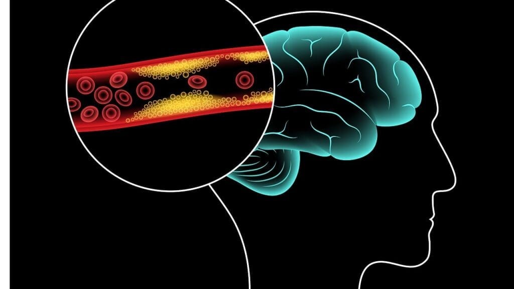 malignant meningioma