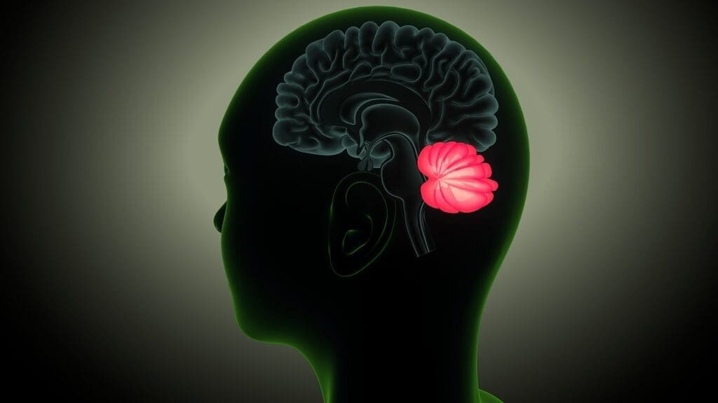 malignant meningioma