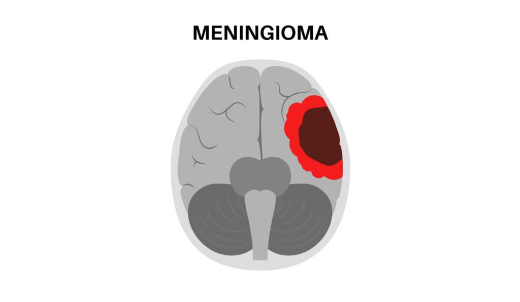 meningioma meningioma