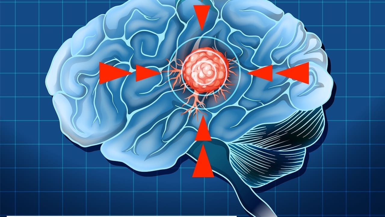 meningioma calcified brain tumor