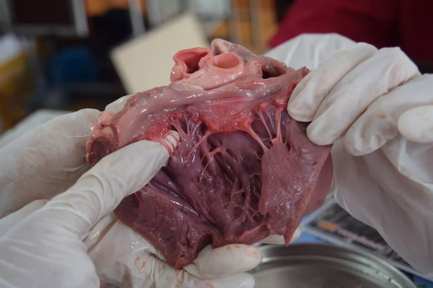 mildly dilated aortic root and ascending aorta