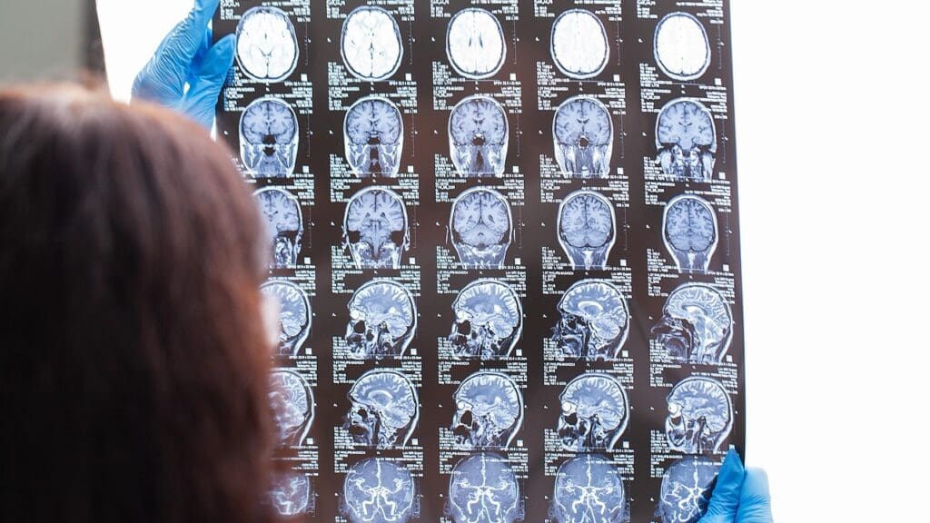 13 Common Symptoms and Key Facts About MRI-Detected Brain Cysts