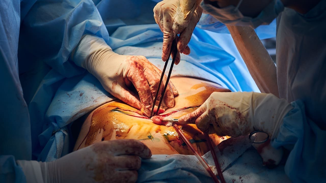 open abdominal aortic aneurysm repair
