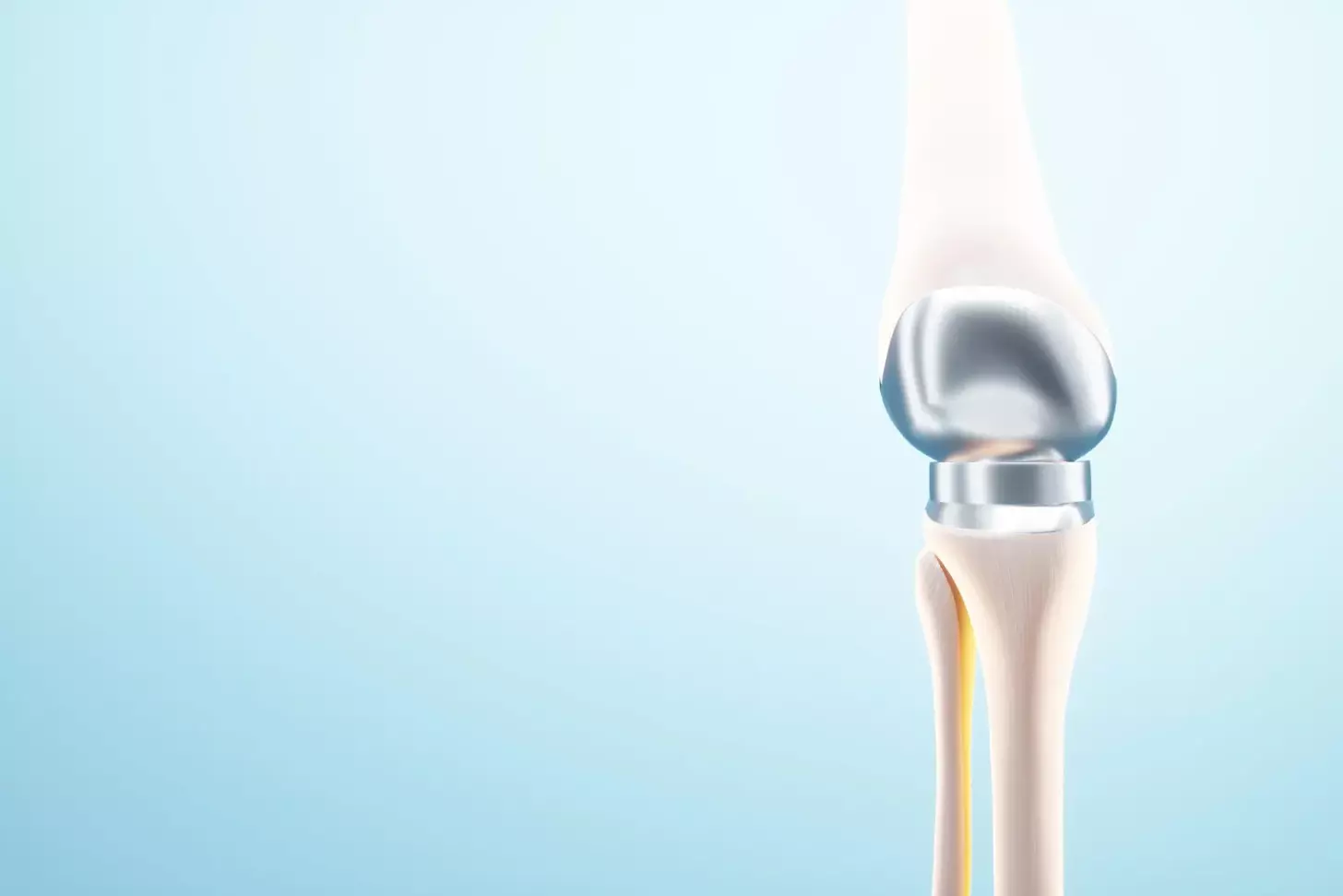 press fit knee replacement