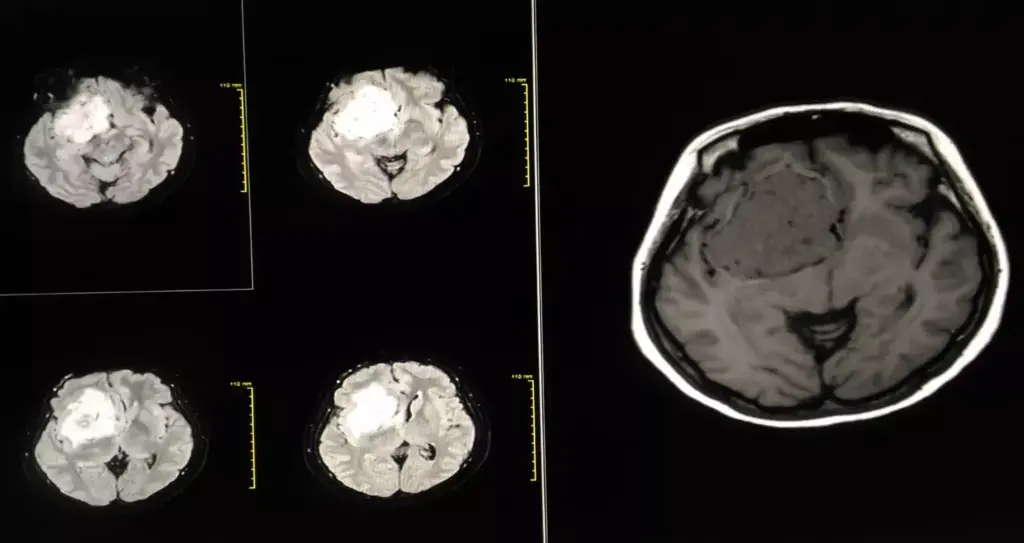 presurgery brain imaging 