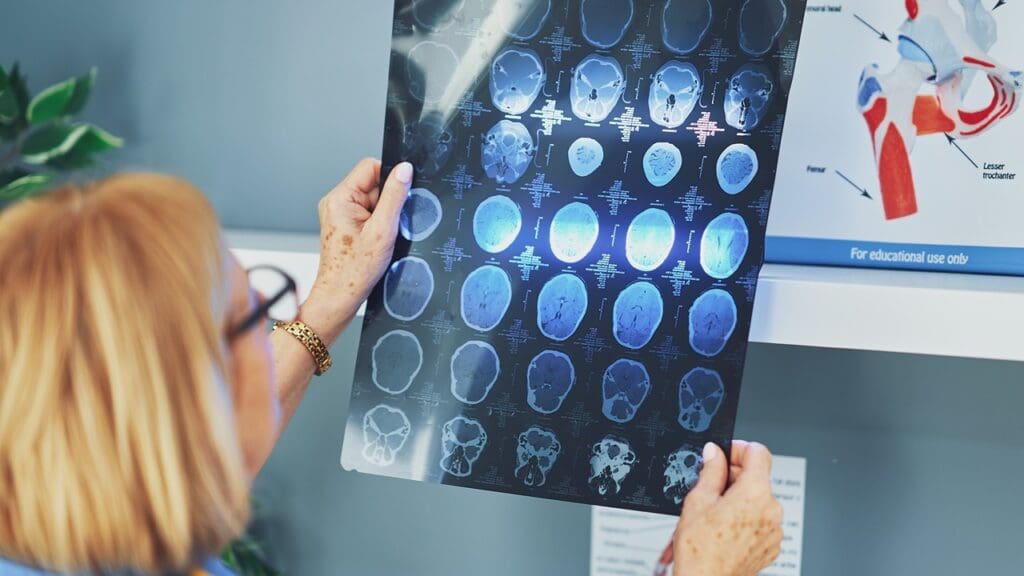 prevalence of choroid plexus cysts prevalence of choroid plexus cysts