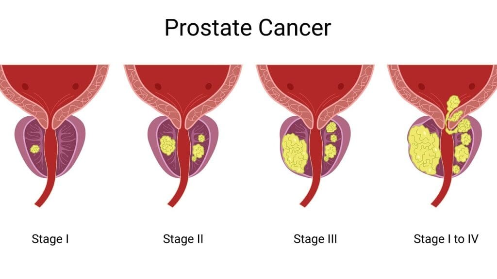 prostate cancer growth rate comparison prostate cancer growth rate comparison
