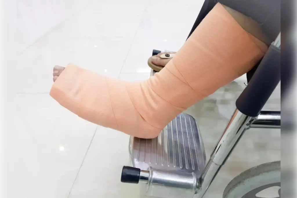 recovery after a bunion operation