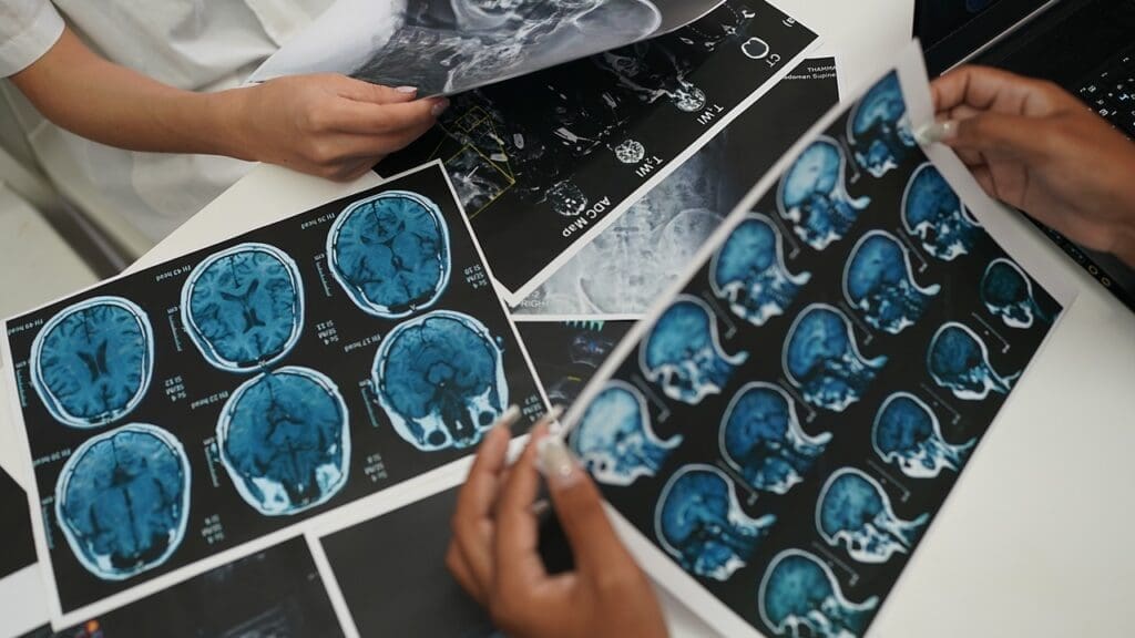 saccular brain aneurysm saccular brain aneurysm