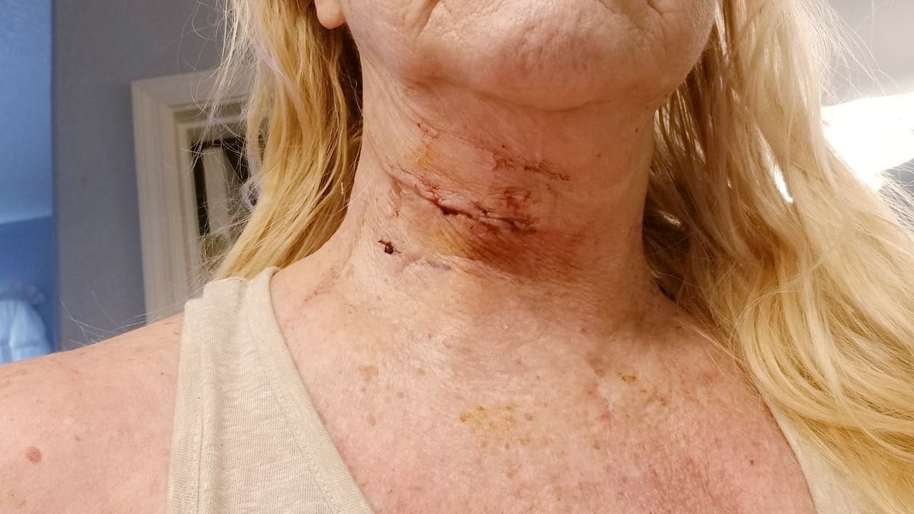 scar from anterior cervical discectomy and fusion