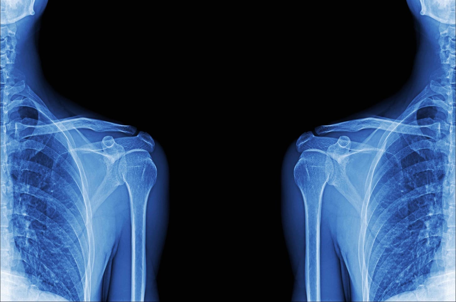 shoulder replacement xray