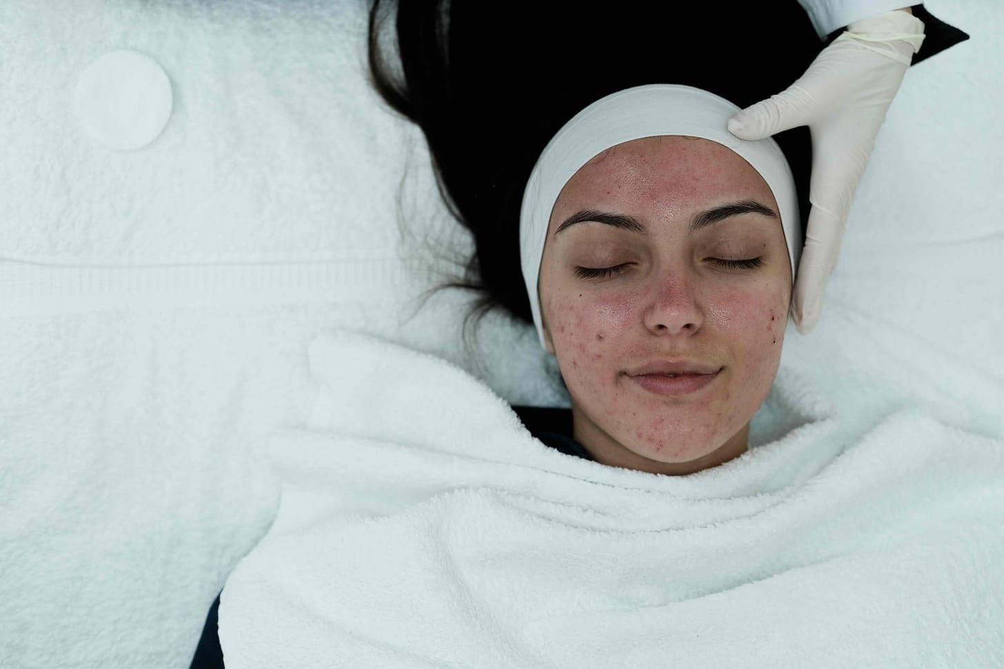 skin cancer removal on face