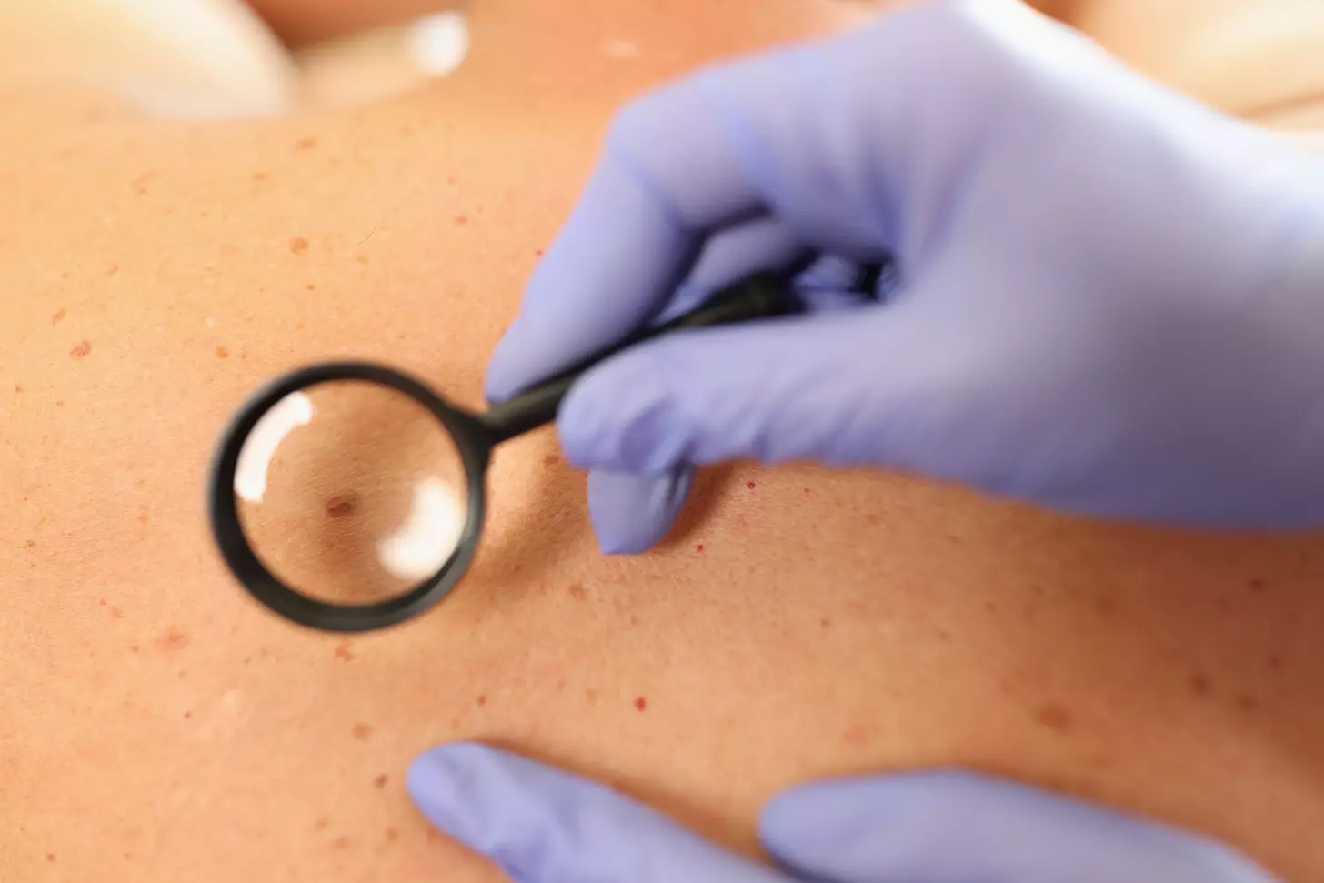 skin cancer removal