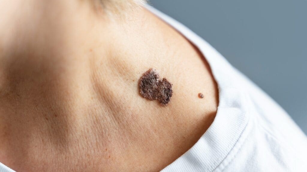 skin cancer severity