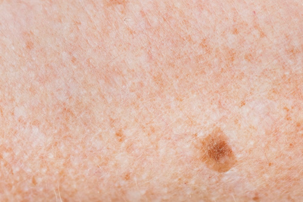 skin nodules