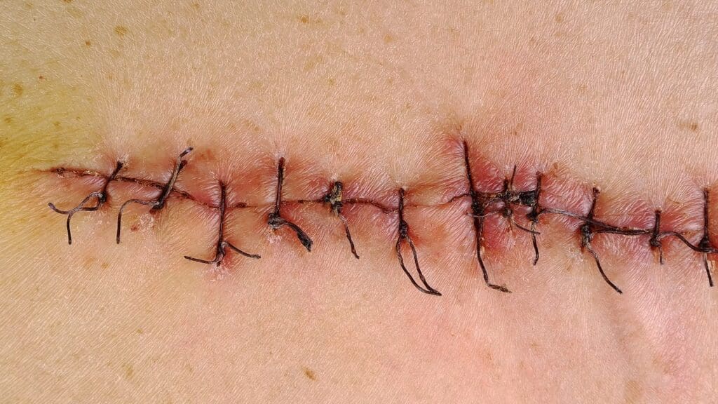 spinal fusion surgery scar