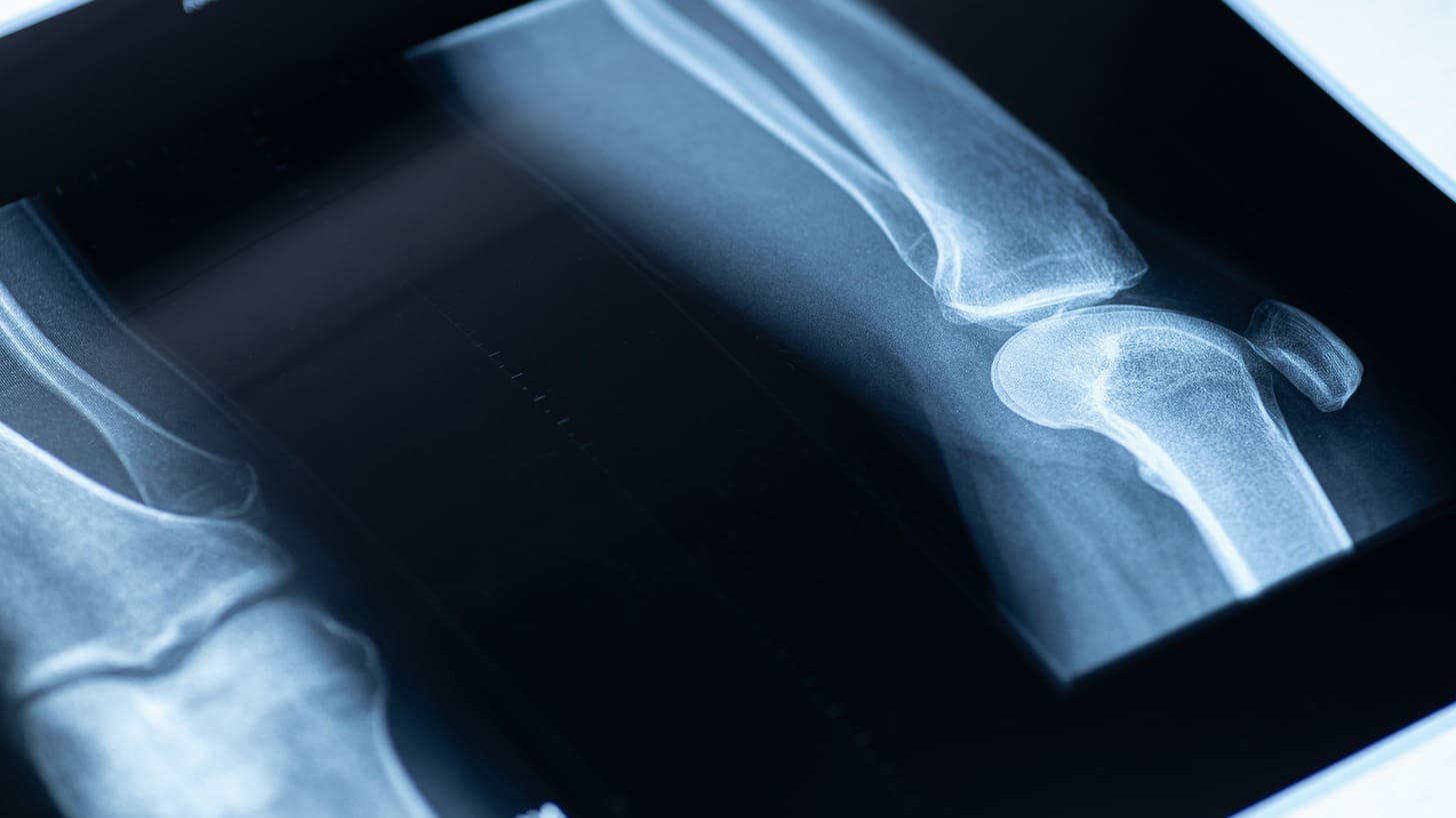 tibial tuberosity