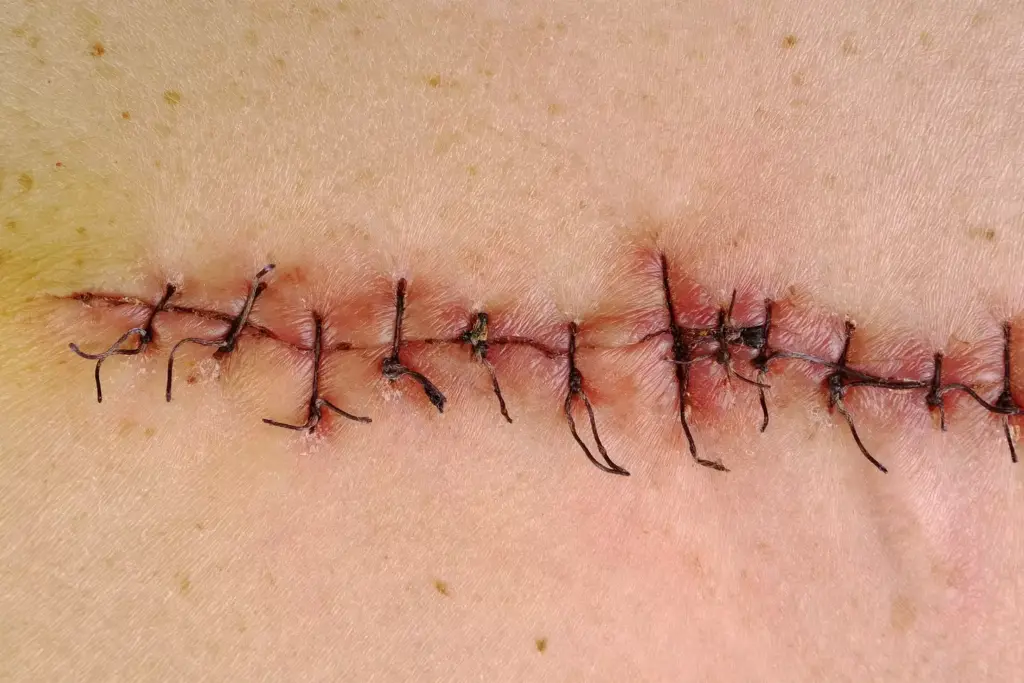 triple bypass scar