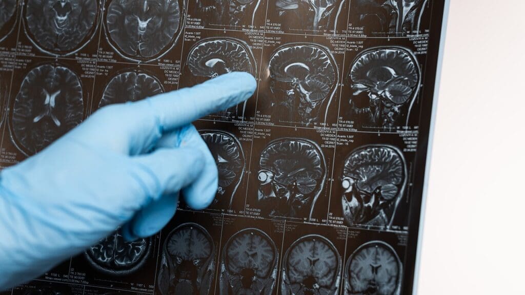 types of brain cysts