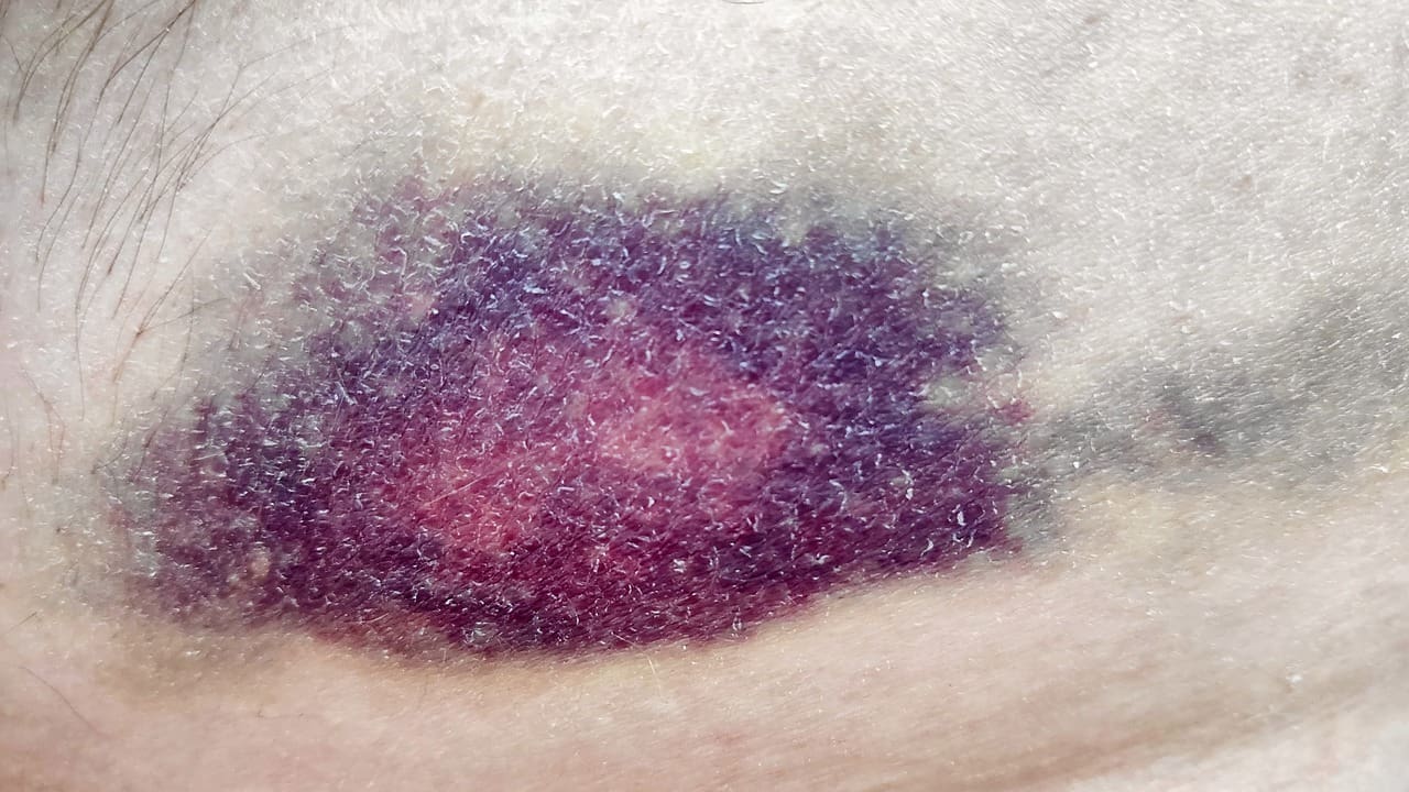 what is manner of death if it was skin cancer