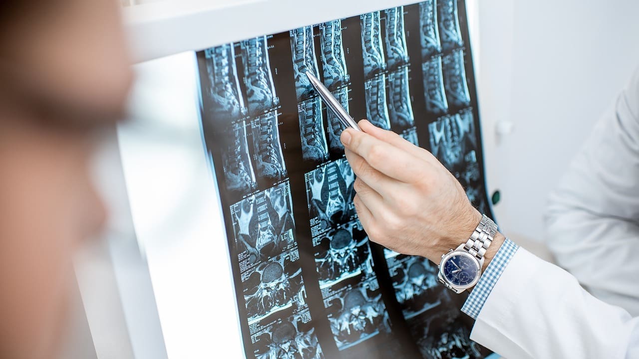 when is spinal fusion necessary