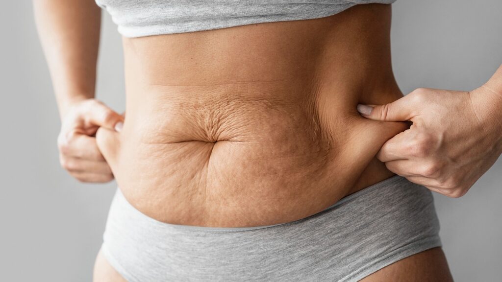loose skin after weight loss surgery
