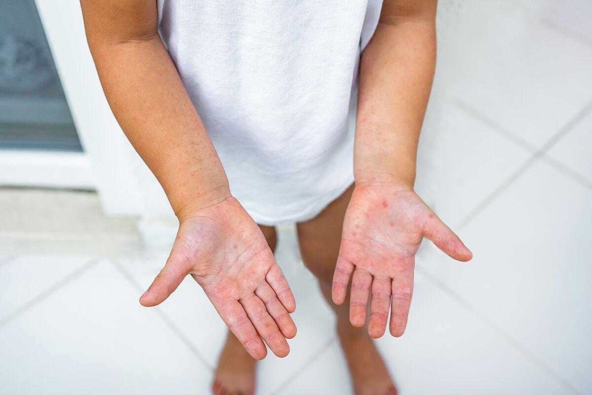 Most Common Childhood Infections