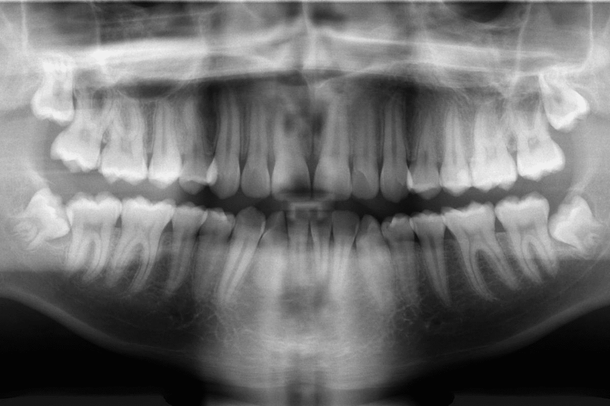 What Is A Panoramic Radiograph And How Does Digital X-Ray Work?