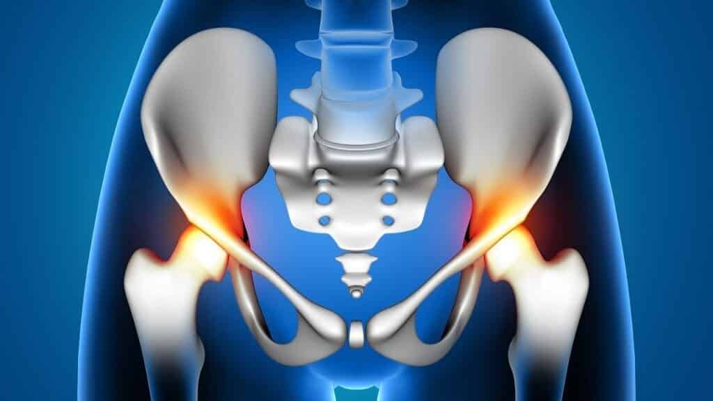 Top 5 Artificial Hip Types: Key Differences in Hip Replacement Implants