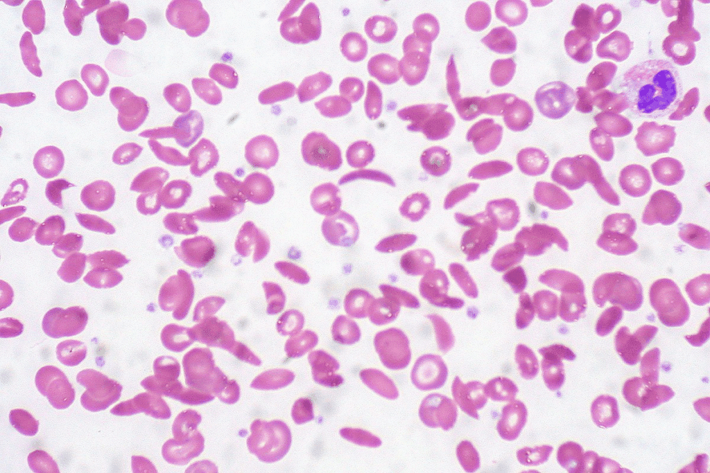 Acute Myeloid Leukemia: Link to Anemia