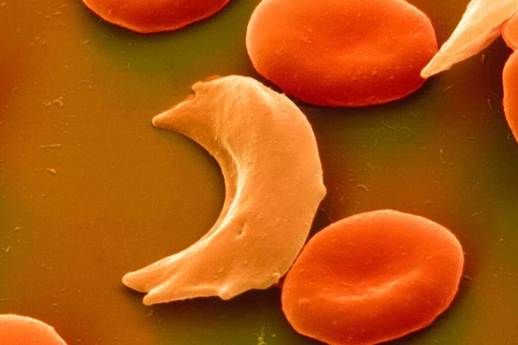 What are the 4 types of sickle cell crisis?