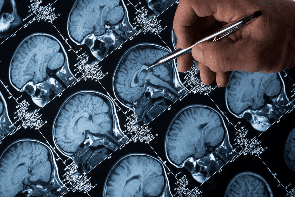 Simplest brain surgery: The #1 procedure revealed