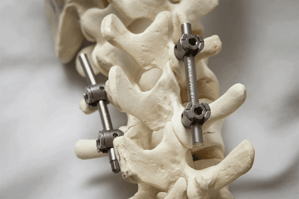 Spinal Stenosis VA Rating: The L4 L5 Fusion Guide