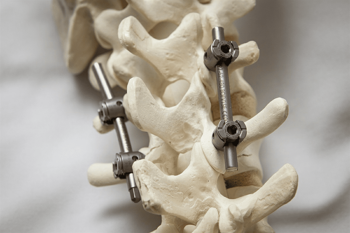 Spinal Stenosis VA Rating: The L4 L5 Fusion Guide