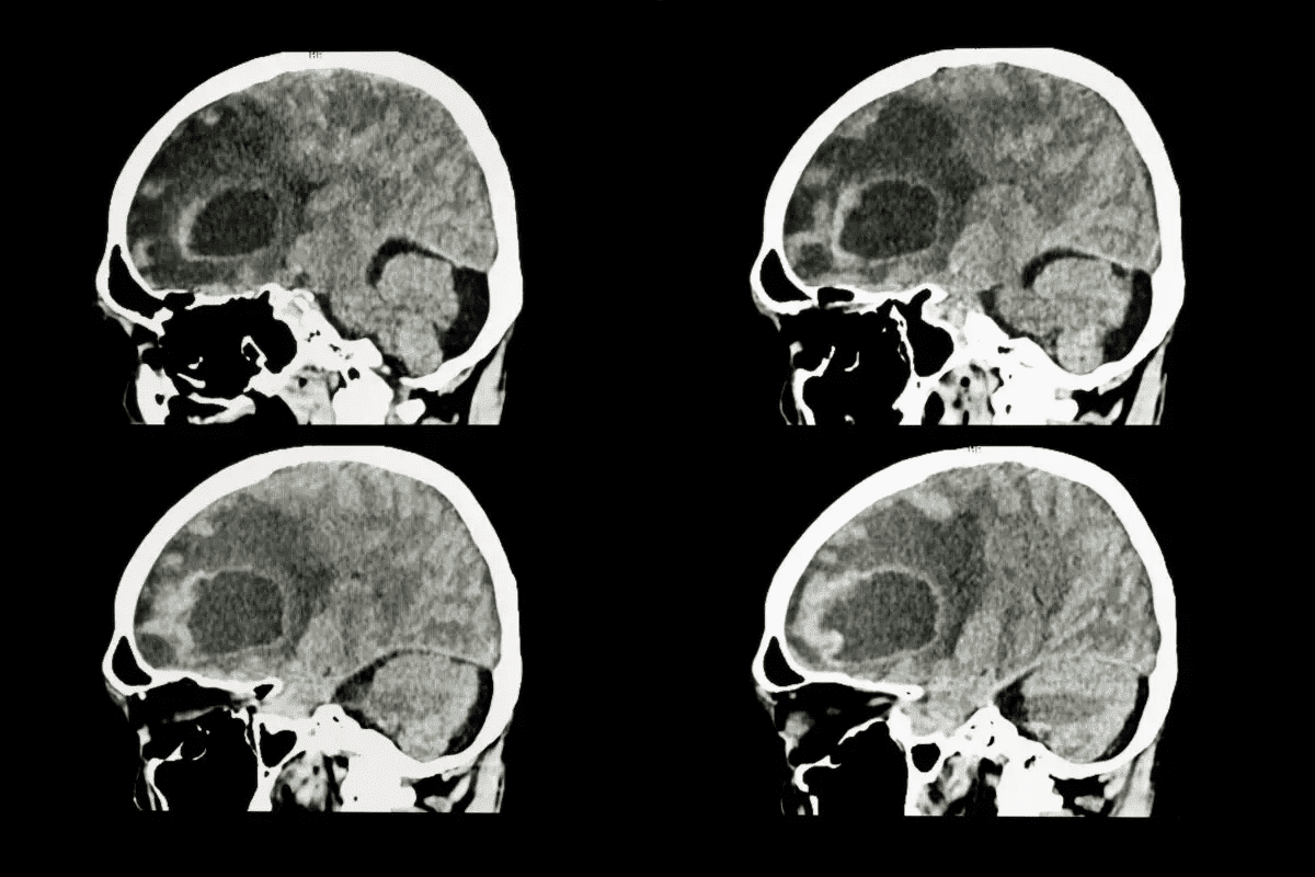 Skull base tumor removal: An amazing, critical guide