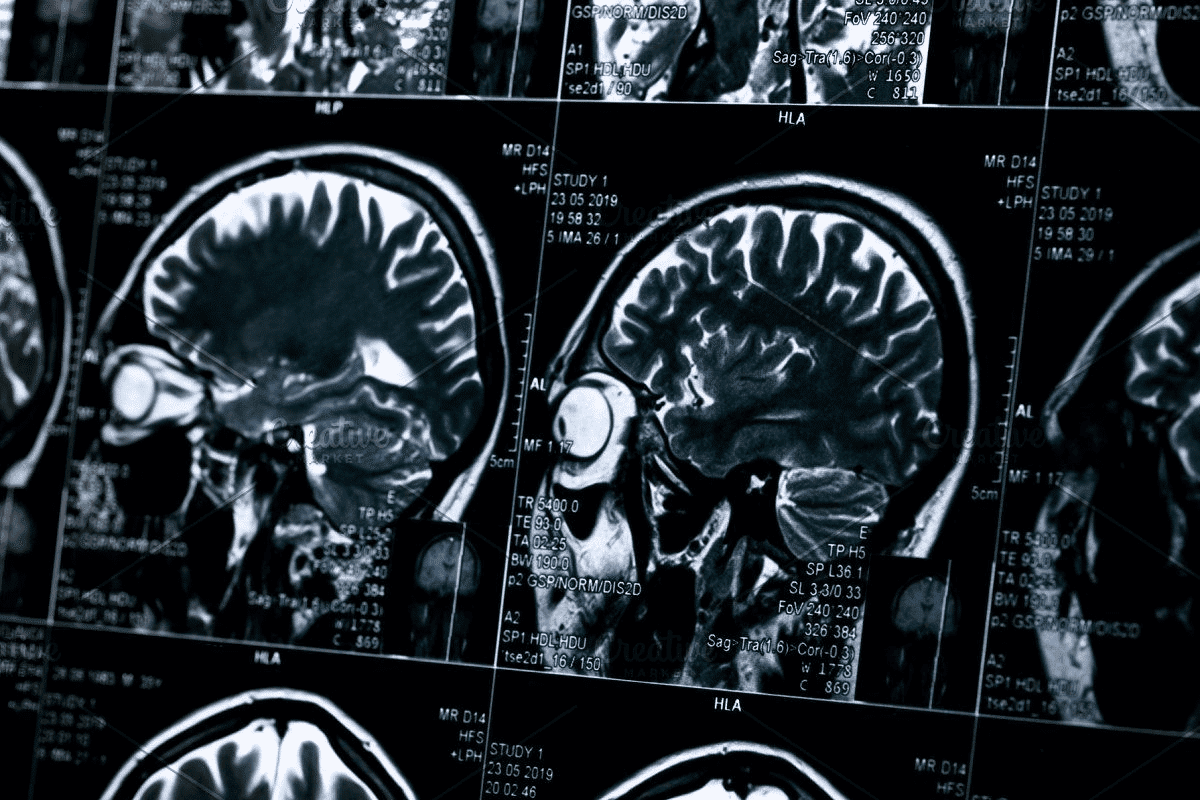 What Does an MRI Show in the Brain? Shocking Facts