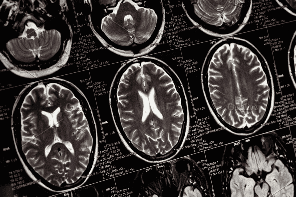 What Does an MRI Show in the Brain? Shocking Facts