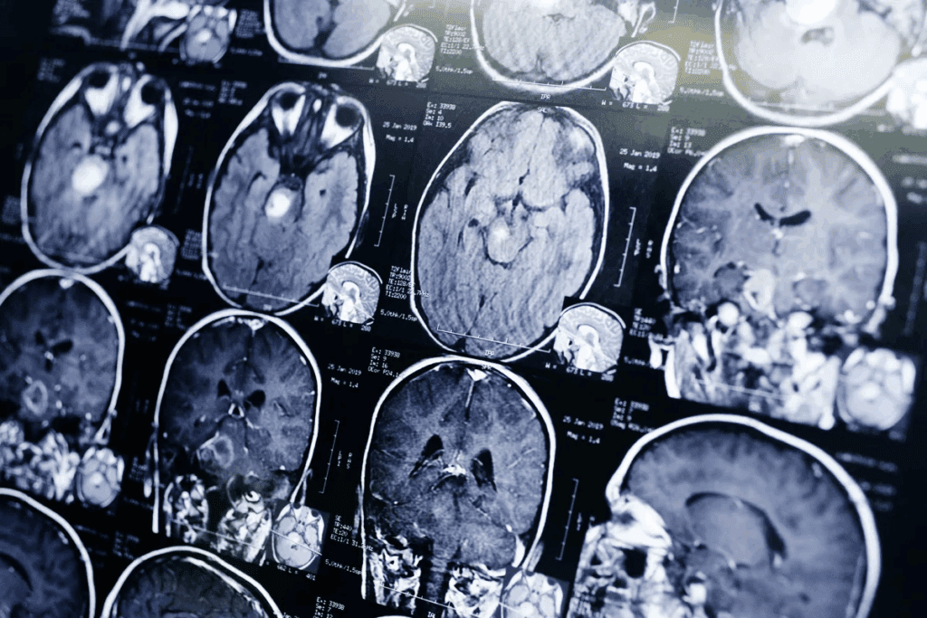 Computed tomography brain scan: Surprising facts