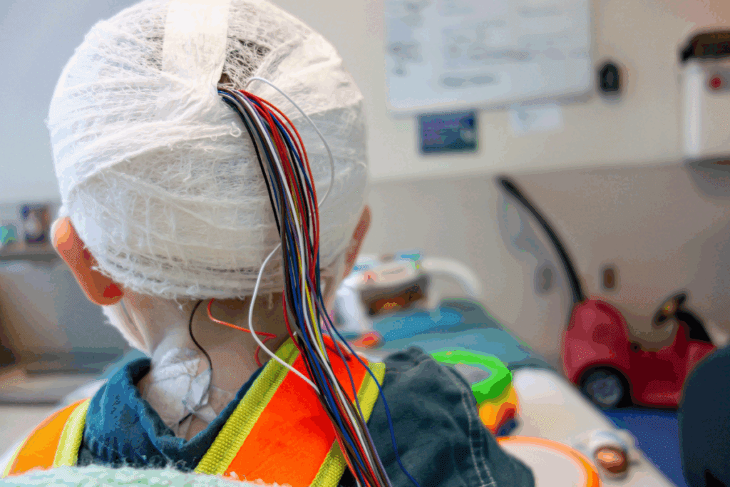 Epilepsy Treatments: The Ultimate, Hopeful Guide