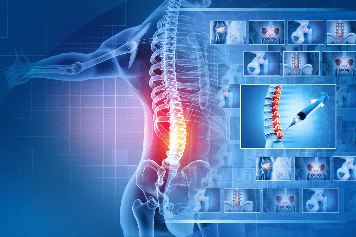 2 Level Cervical Fusion Settlement Workers' Compensation
