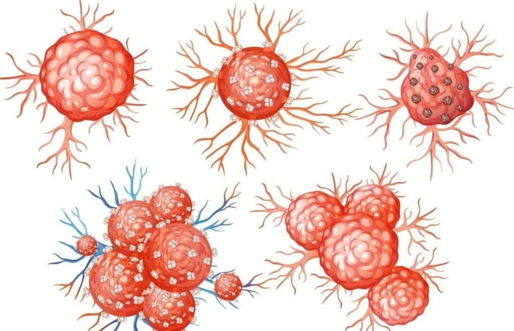 Benign Tumor Symptoms: 10 Common Signs, Causes, and Types Explained