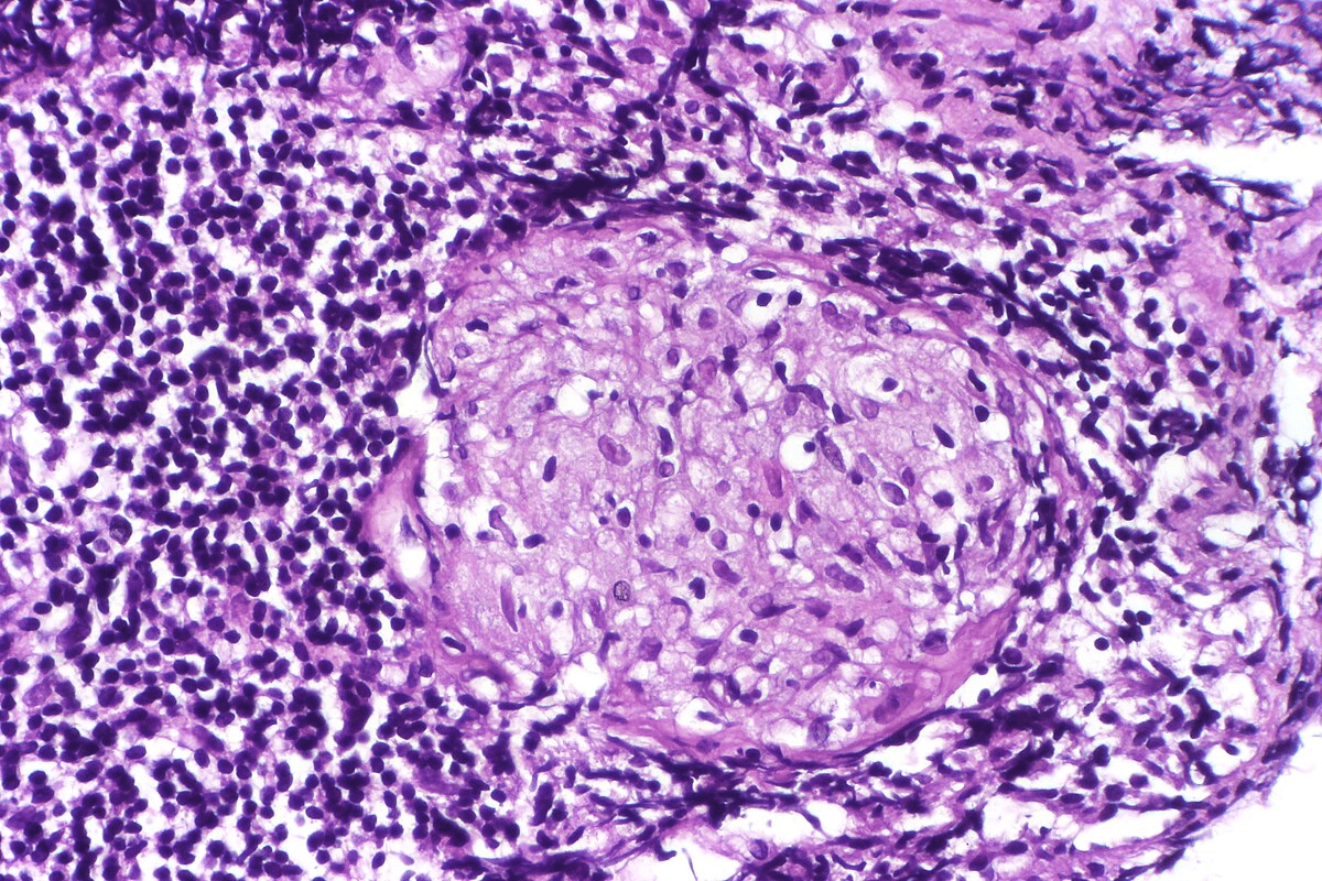 Oral Biopsy: Your Ultimate 5-Step Prep Guide