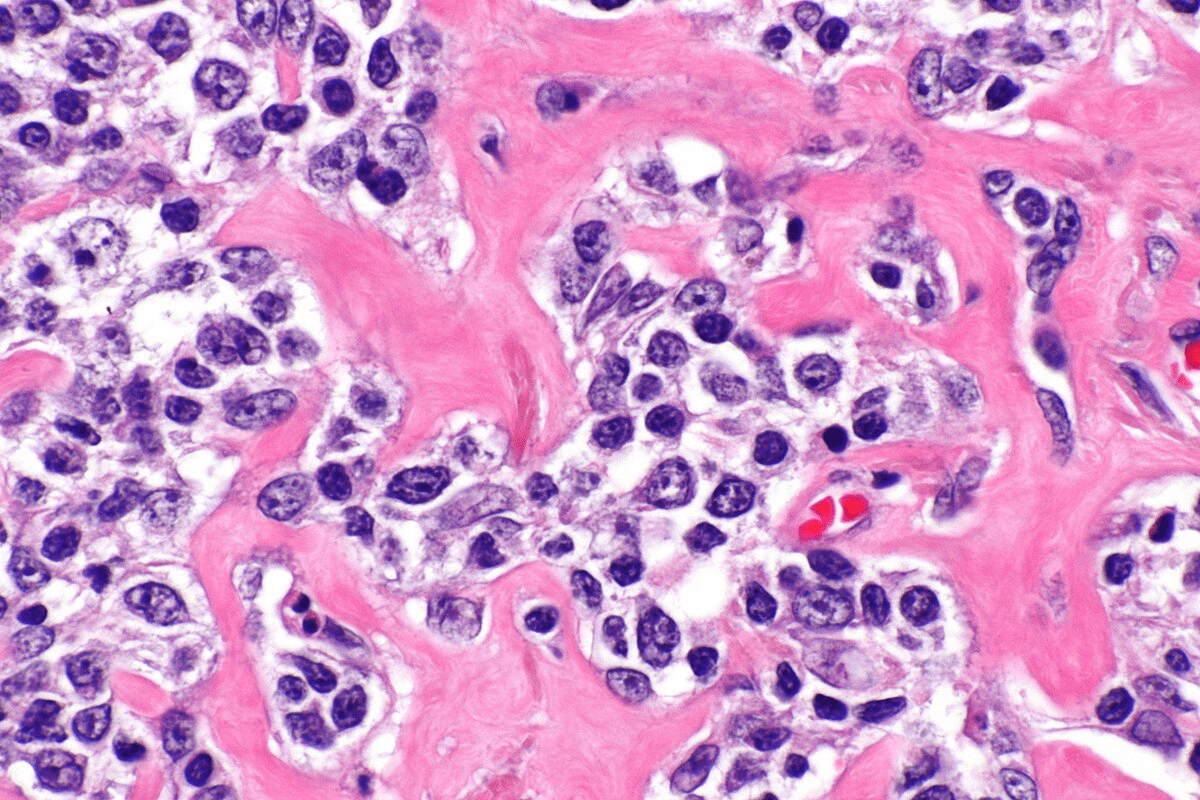 High Childhood cancer cure rates: The Success of Modern Treatment