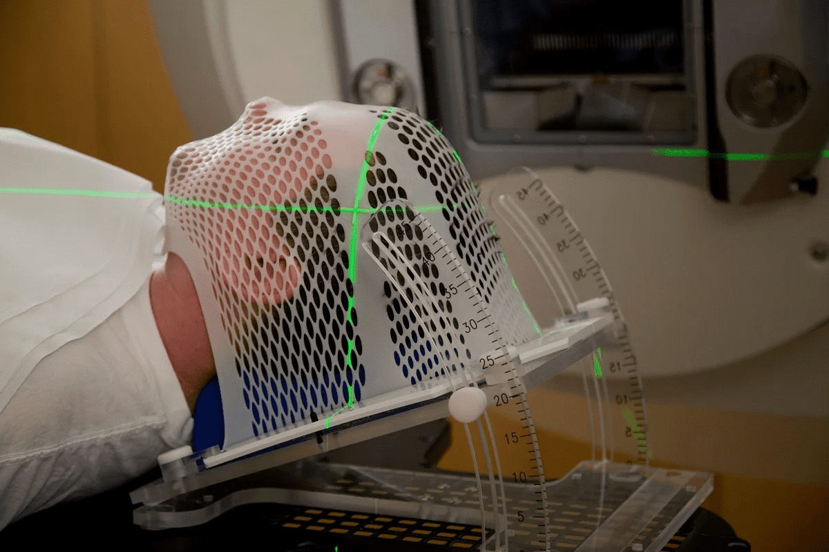 Radiation Therapy Long-Term Effects to Know