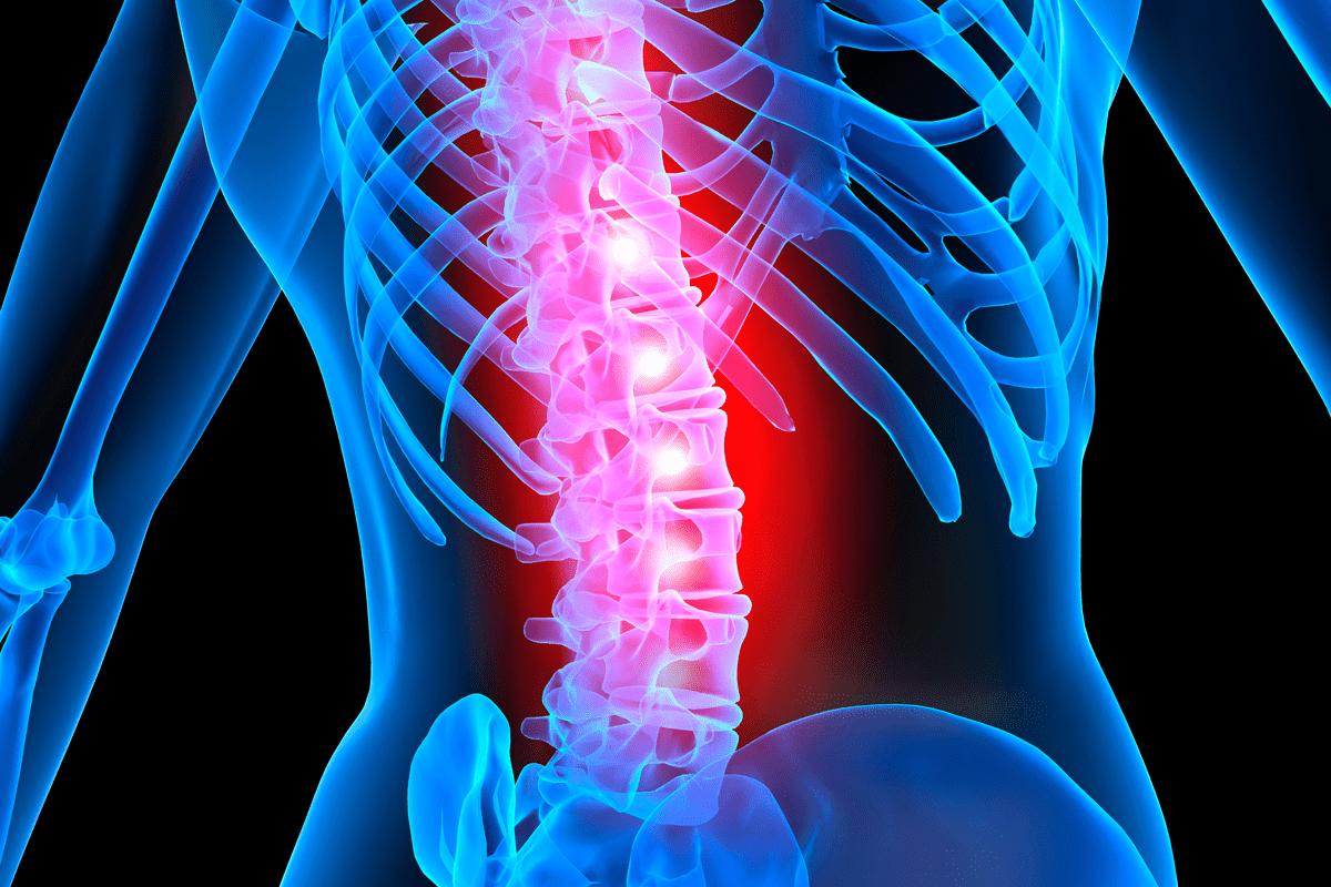 Key Disc Bulge Solution Surgery for L4-L5