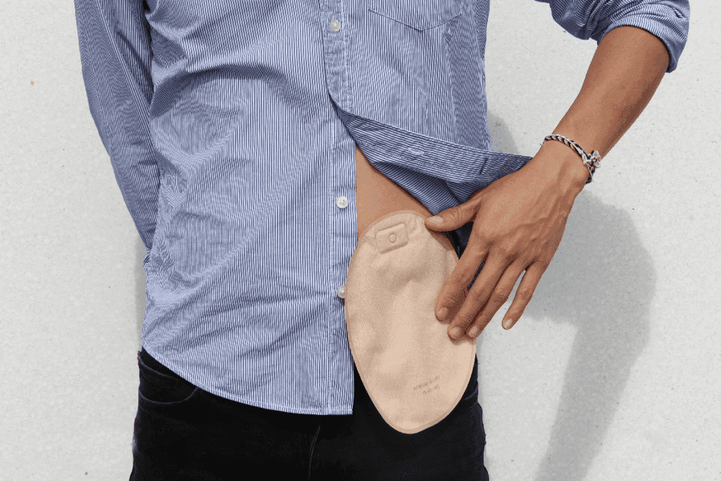 Colostomy Bag Alternatives: New Options Explained