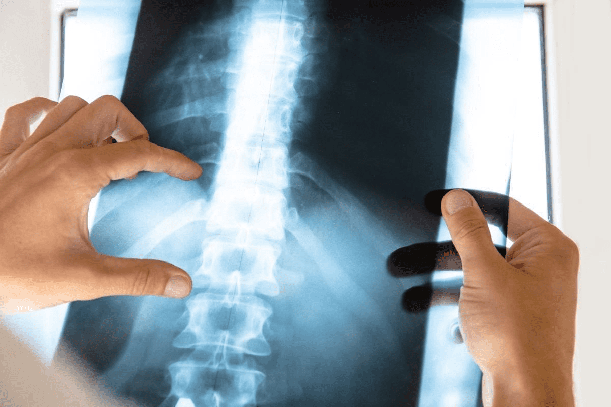 Crucial Restrictions After L5 S1 Laminectomy Microdiscectomy