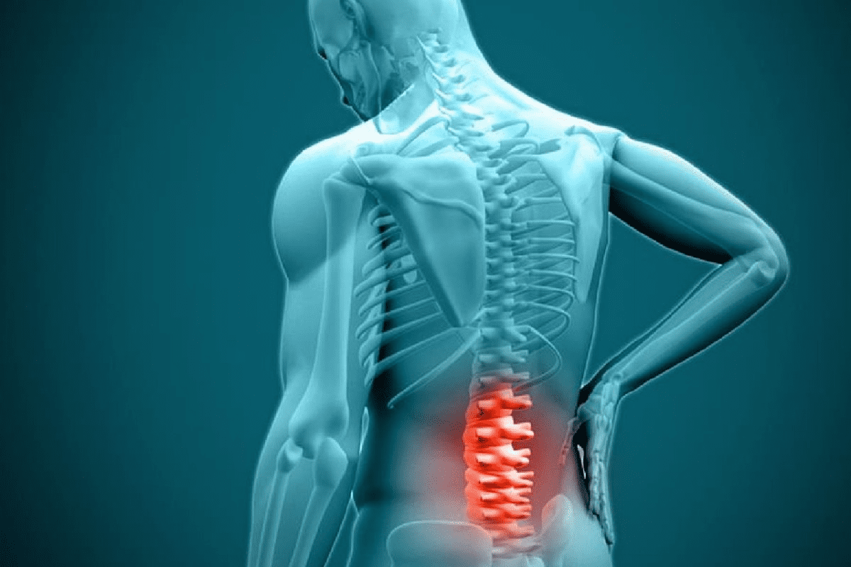 Key What is the Best Painkiller For Spinal Stenosis